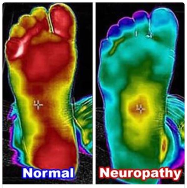 Thermal imaging showing neuropathy foot treatment at Made Ya Skinny med spa