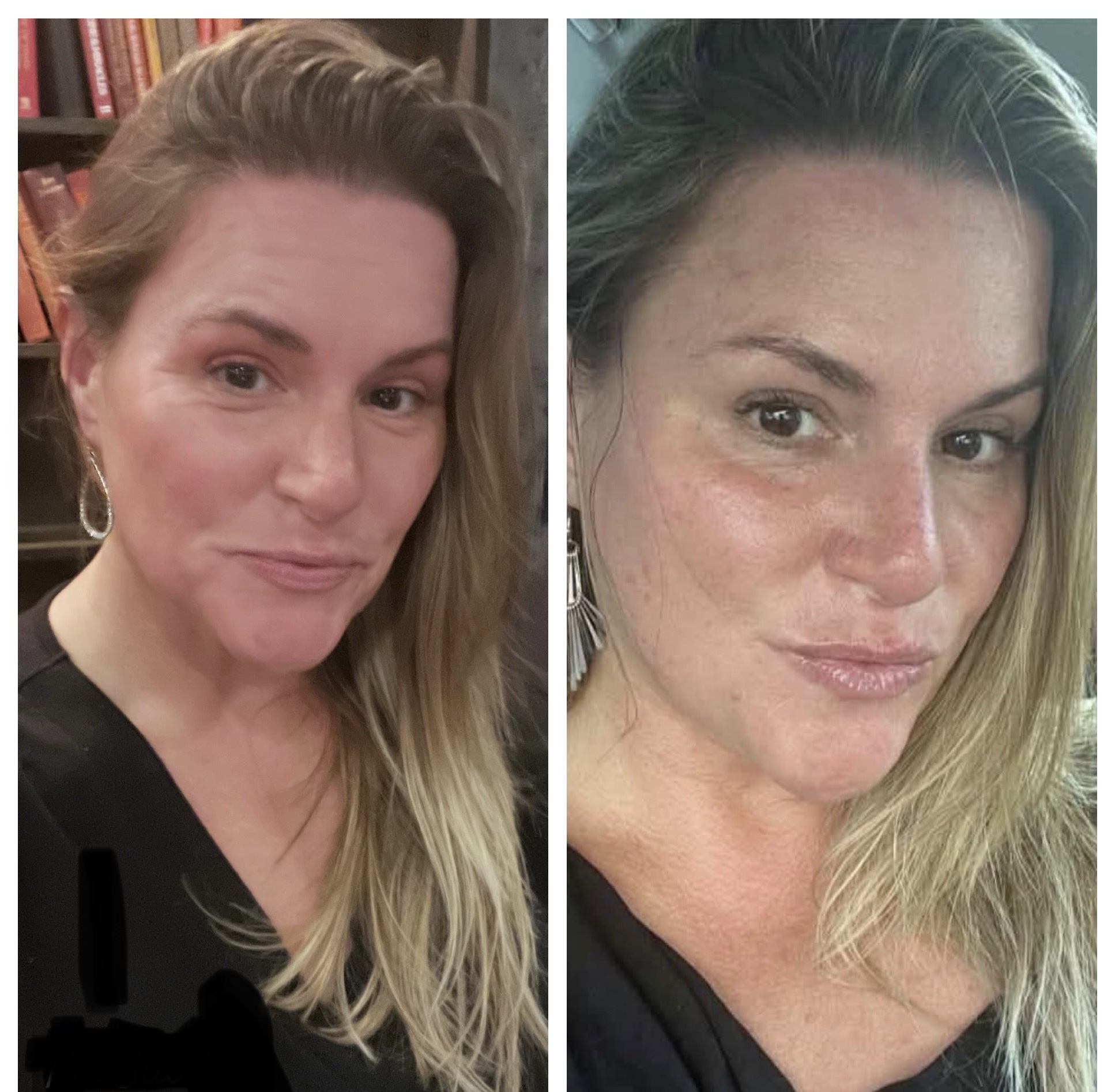 Made Ya Skinny patient before and after Botox to the forehead and the lines between the brows. Both photos are unretouched; the second has no makeup.