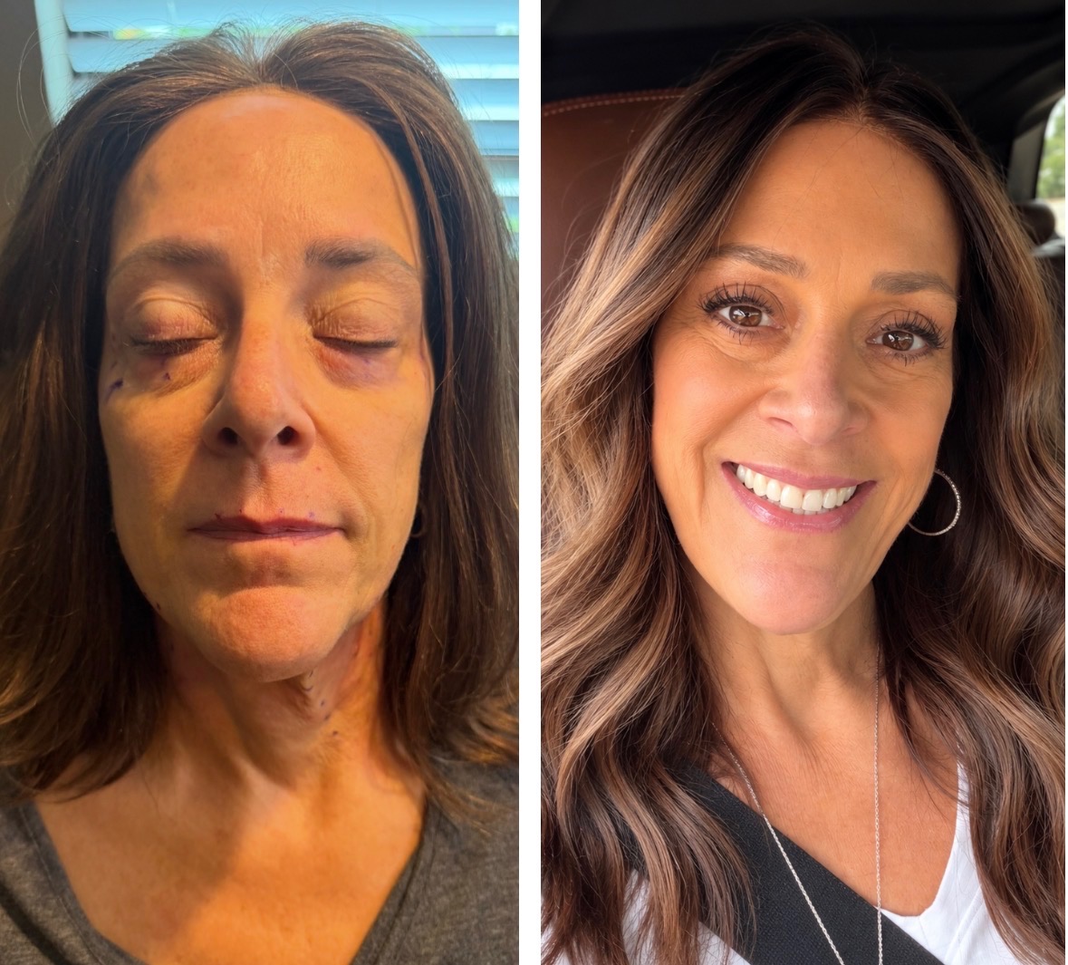Made Ya Skinny patient before and after Botox treatment, full face and neck.